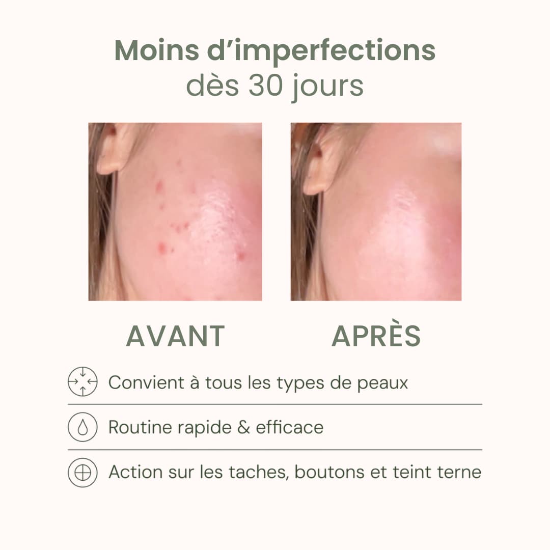 Avant Après Routine Anti-Imperfections Framb - Résultats visibles en 30 jours