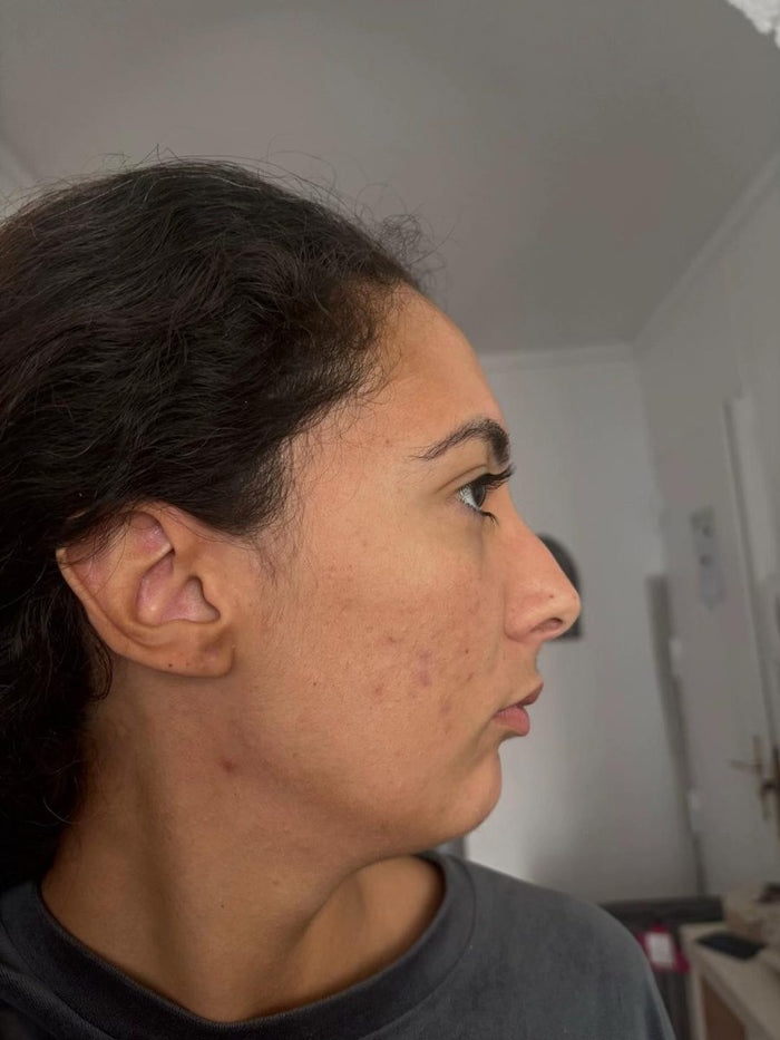 Visage avec imperfections, avant