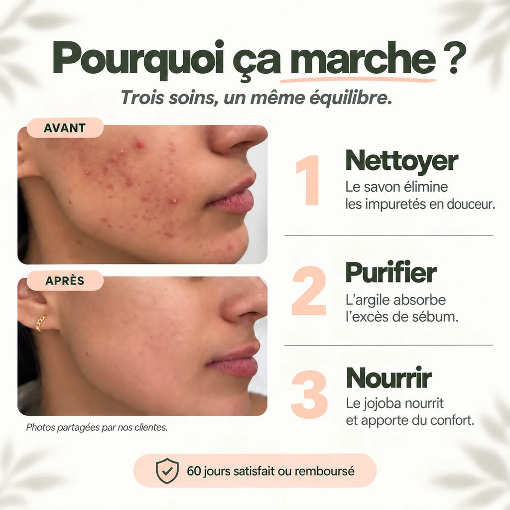 Pourquoi la routine anti-imperfections Framb marche : nettoyer, purifier, nourrir, avant / après cliente