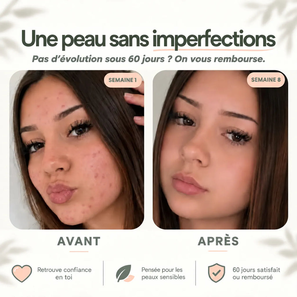 Avant / après 8 semaines de routine anti-imperfections Framb, photo cliente