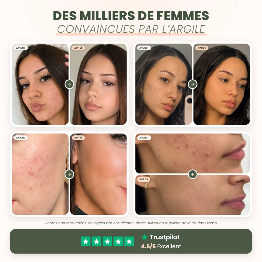 Avant / après de 4 clientes de la routine anti-imperfections Framb